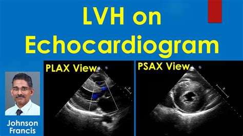 lv hypertrophy meaning|what is lvh on echocardiogram.